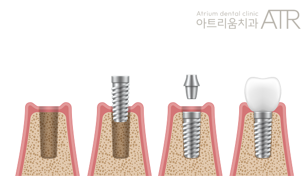 평택 임플란트, 임플란트 후 음식물 끼임 정상인가요? - 3