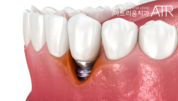 평택 임플란트, 임플란트 후 음식물 끼임 정상인가요? - 4