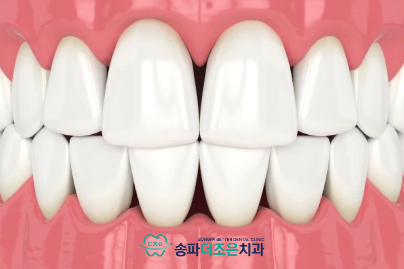 송파나루역치과, 치아 사이 검은 공간은 왜 생기는 걸까요? 블랙트라이앵글 원인과 레진으로 해결 가능할까?