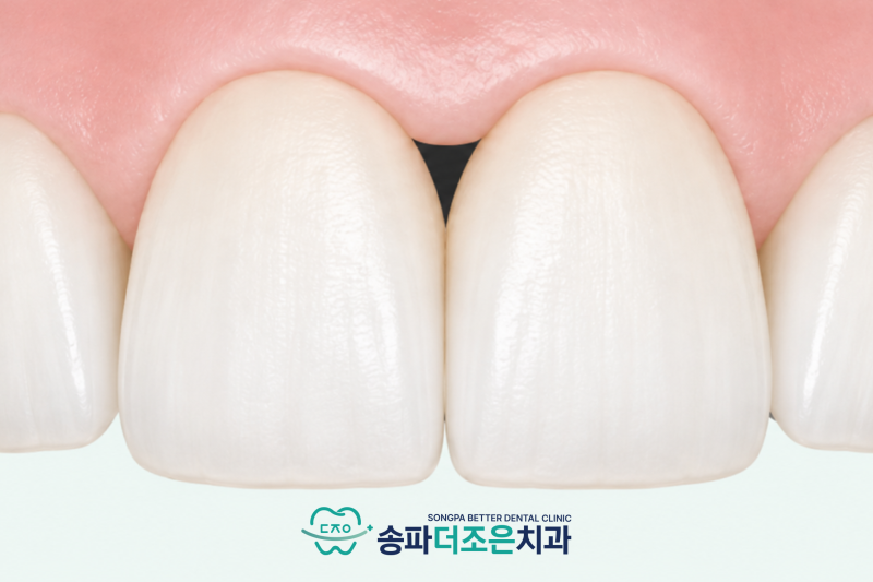 송파나루역치과, 치아 사이 검은 공간은 왜 생기는 걸까요? 블랙트라이앵글 원인과 레진으로 해결 가능할까? - 2