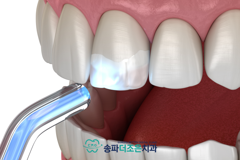 송파나루역치과, 치아 사이 검은 공간은 왜 생기는 걸까요? 블랙트라이앵글 원인과 레진으로 해결 가능할까? - 3