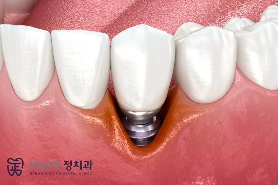 노원역 임플란트 잘하는 곳은 계획부터 다릅니다 - 3