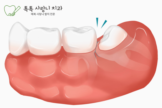 대구 사랑니 발치, 무서운데 방치하면 안 되나요?