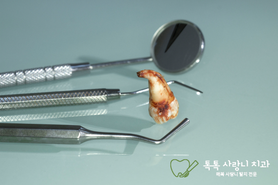 대구 사랑니 발치, 무서운데 방치하면 안 되나요? - 4