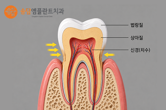 화양지구치과, 치아가 시릴 때 의심해 볼 수 있는 대표적인 질환 - 1