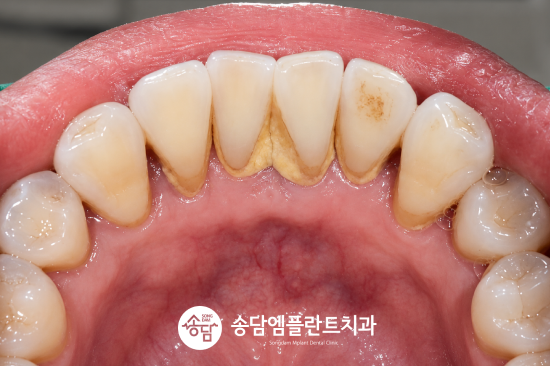 화양지구치과, 치아가 시릴 때 의심해 볼 수 있는 대표적인 질환 - 2