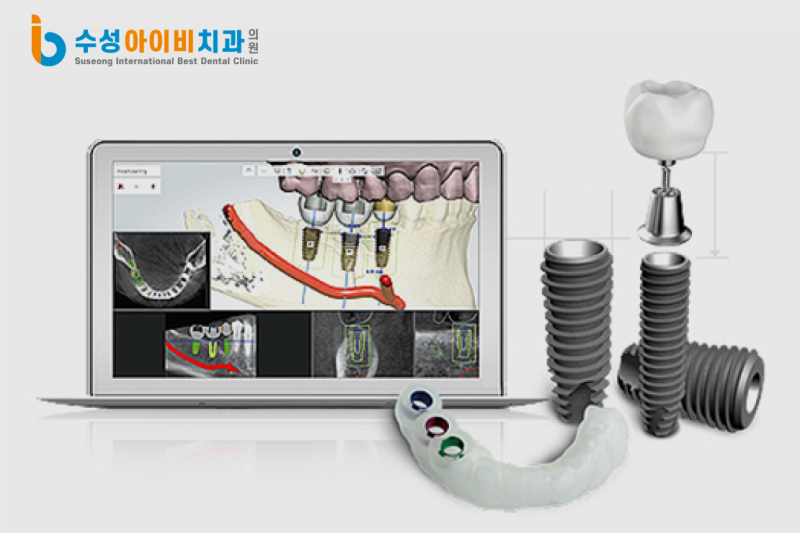 범어1동 임플란트, 디지털 임플란트란 무엇일까요? - 2