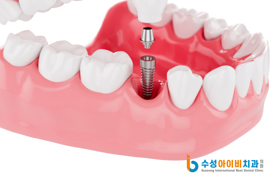 범어1동 임플란트, 디지털 임플란트란 무엇일까요? - 4