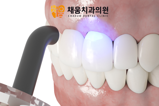 사가정역 앞니 레진, 깨진 치아도 자연스럽게 복원할 수 있을까요? - 1