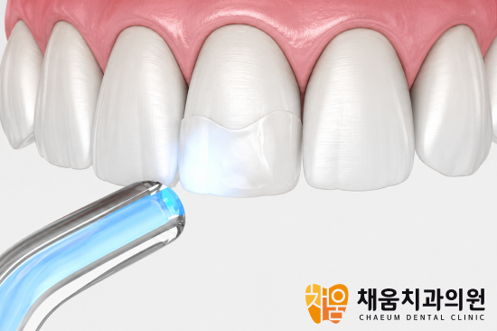 사가정역 앞니 레진, 깨진 치아도 자연스럽게 복원할 수 있을까요?