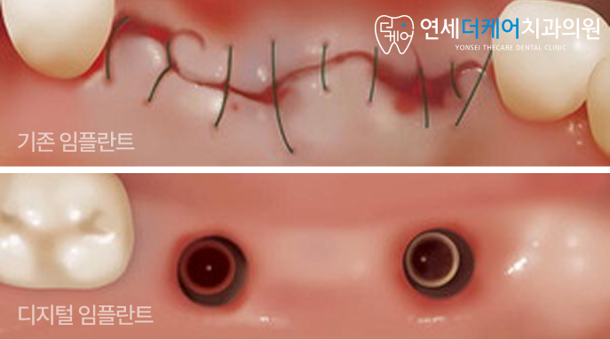 아름동 임플란트, 기존 방식과 디지털 방식의 차이는? - 3