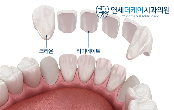 세종 라미네이트, 치아 삭제가 걱정되신다면? 이 글만 보세요 - 3