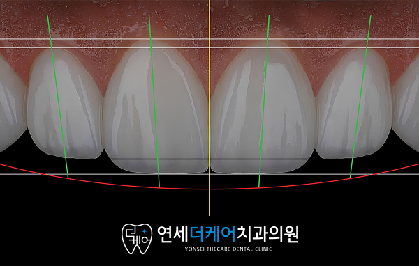 세종 라미네이트, 치아 삭제가 걱정되신다면? 이 글만 보세요 - 5