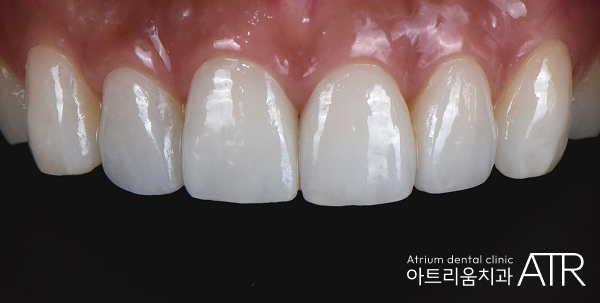 평택 라미네이트 치과, 비용보다 먼저 확인할 5가지 기준
