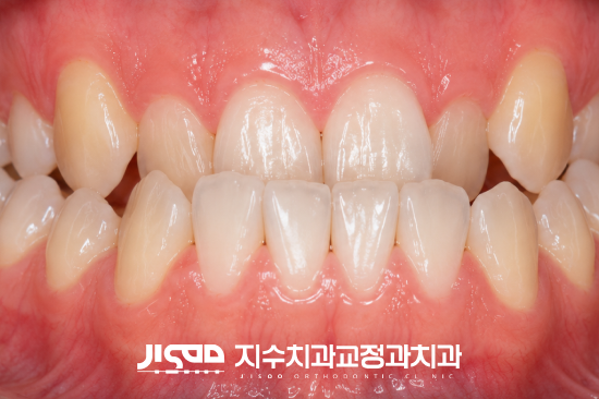 대구 비발치 교정: MARPE로 치아 배열 개선하기 - 4