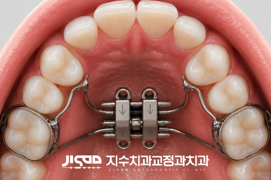 대구 비발치 교정: MARPE로 치아 배열 개선하기 - 5