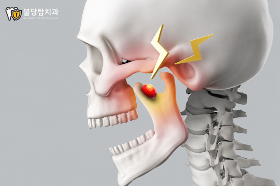 턱관절 치료 후 관리 방법 관련 이미지