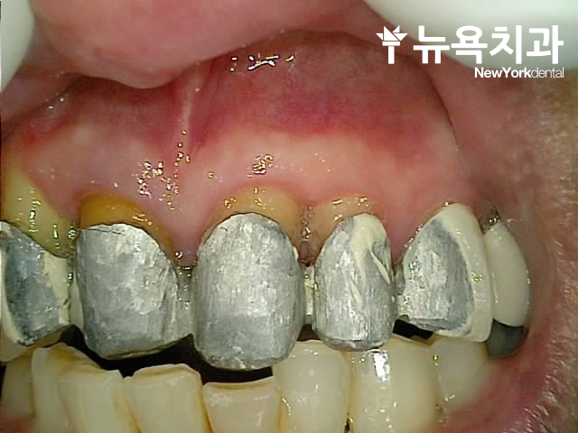 인천 남동구 앞니 브릿지 치료 사례: 심미적 문제 해결 과정