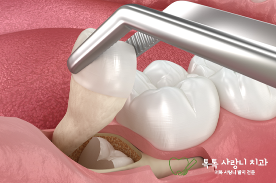 대구 남구 사랑니 치과: 안전한 발치와 회복을 위한 가이드