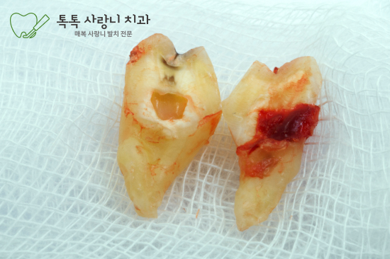 사랑니 발치의 필요성 관련 이미지
