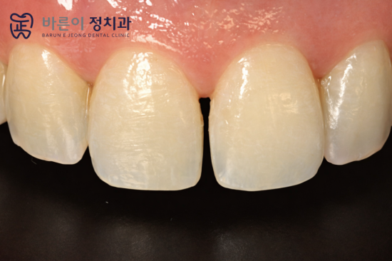 노원구 벌어진 앞니 치료: 바이오 클리어와 일반 레진의 차이점