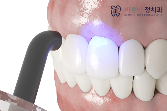 일반 레진 치료와의 차이점 관련 이미지