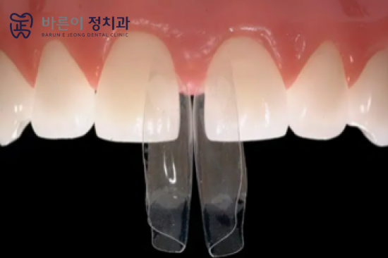 바이오 클리어 치료란? 관련 이미지