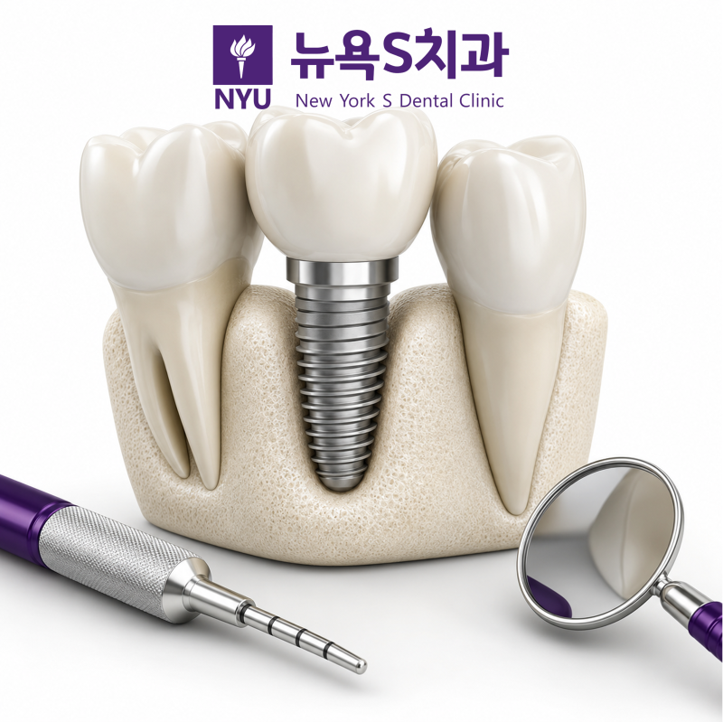 종로구 상악동 거상술: 임플란트 식립을 위한 필수 과정