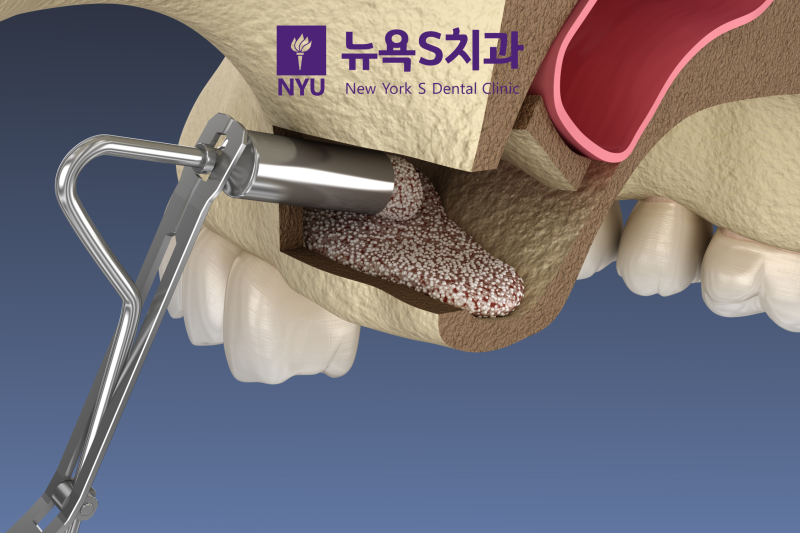 상악동 거상술이란? 관련 이미지