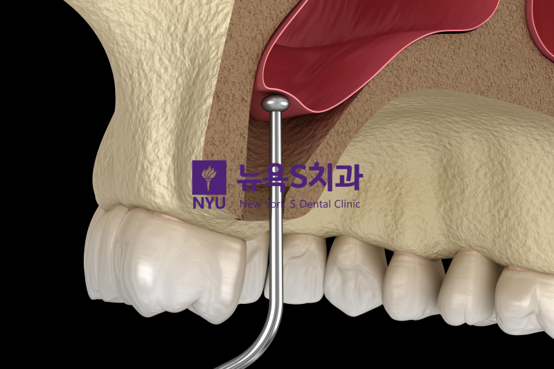 상악동 거상술의 과정 관련 이미지