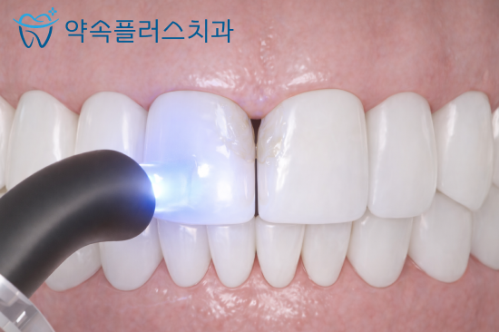 지제역 앞니 레진 치료: 벌어진 앞니의 해결 방법과 주의사항
