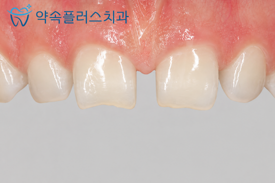 레진 치료의 한계는 무엇인가요? 관련 이미지