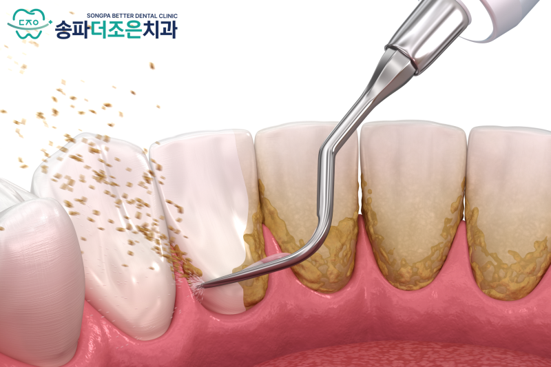 치아와 잇몸 상태에 따라 미백 방법이 어떻게 달라지나요? 관련 이미지