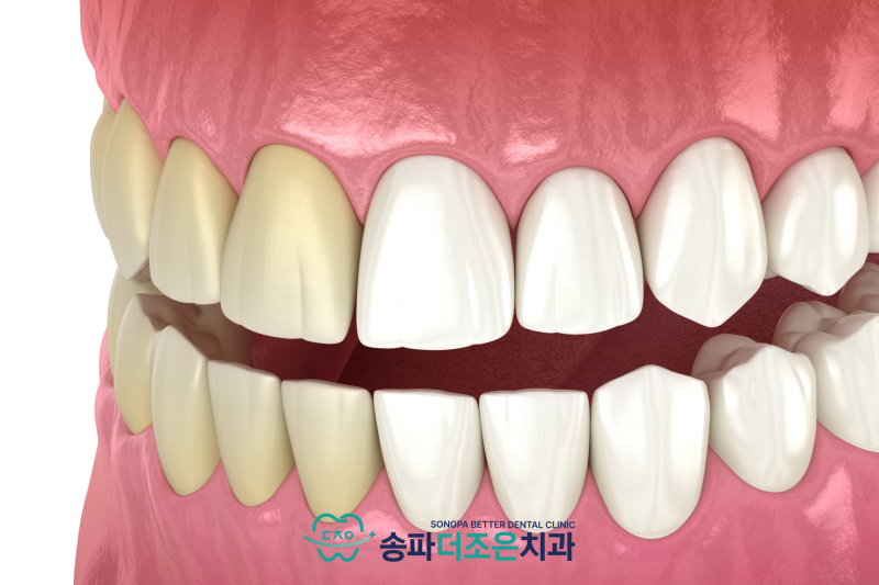 원데이 치아미백을 받기 전에 어떤 검사가 필요한가요? 관련 이미지