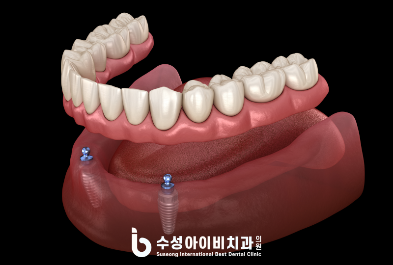 대구 수성구 전체 임플란트: 치아 상실 시 고려해야 할 치료 방법