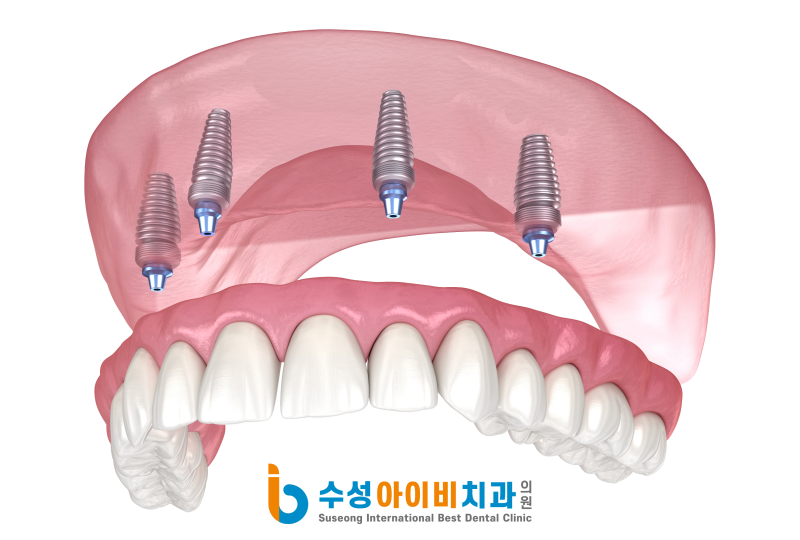 전체 임플란트란 무엇인가? 관련 이미지