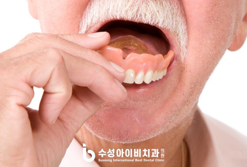 전체 임플란트가 필요한 경우는 언제인가요? 관련 이미지