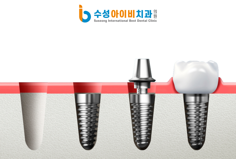 전체 임플란트의 장점은 무엇인가요? 관련 이미지