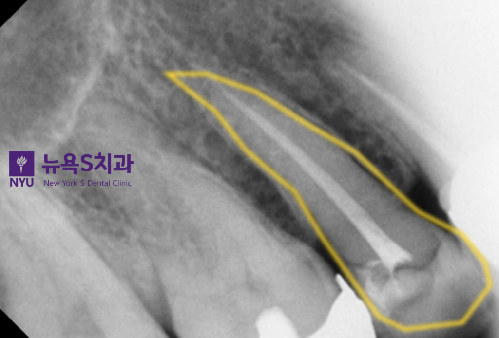 종로3가치과 치아 통증 신경치료 설명