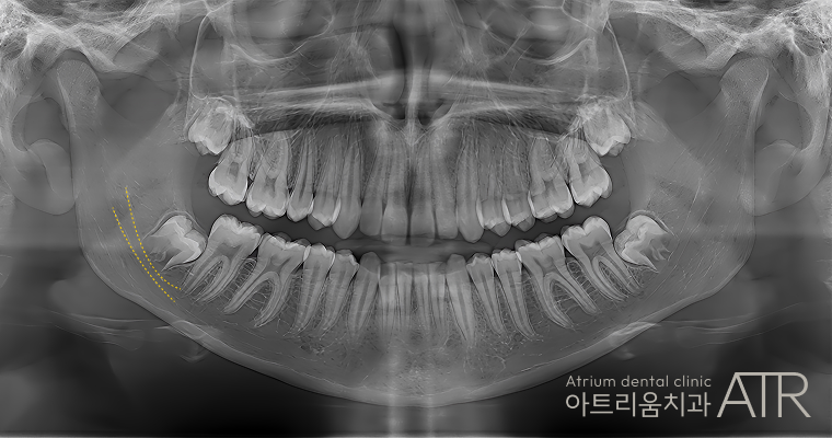 사랑니 발치 시 고려해야 할 요소는 무엇인가요? 관련 이미지