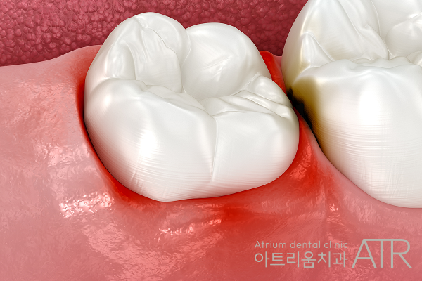 대학병원에서 발치를 권유받았을 때 어떻게 해야 하나요? 관련 이미지