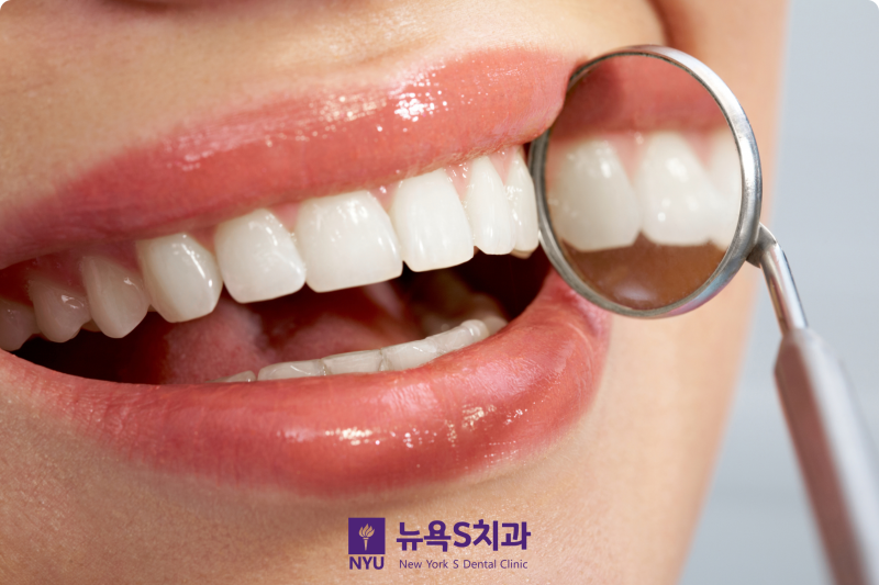 서울 치아미백: 안전한 치료를 위한 필수 검사와 기대 결과