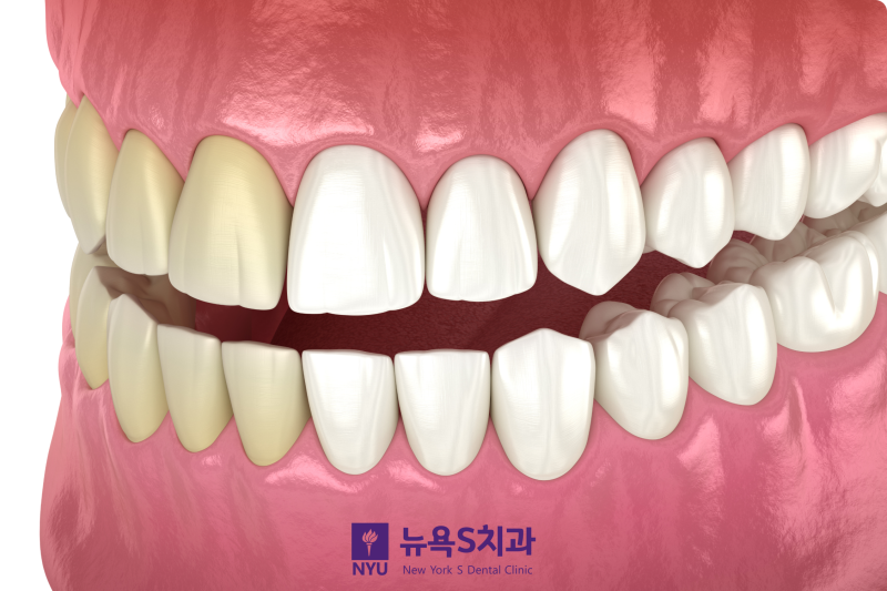 치아미백 후 얼마나 밝아질 수 있나요? 관련 이미지