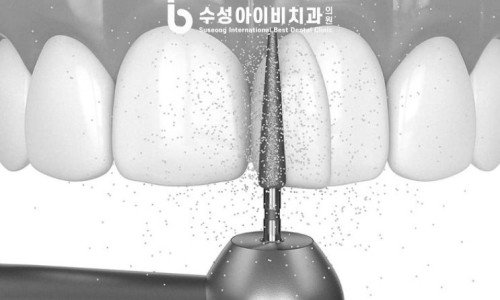 라미네이트 치료 과정은 어떻게 진행되는가? 관련 이미지